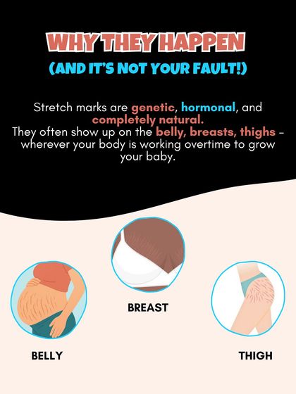Stretch marks are genetic, hormonal, and completely natural. They often show up on the belly, breasts, and thighs where your body is working overtime to grow your baby.
