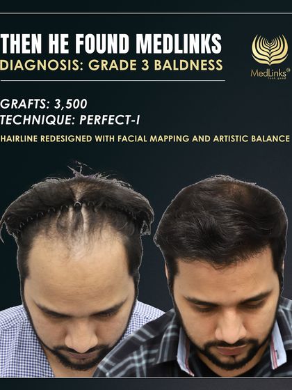 Here you can see the 'before' state and the initial markings for the new hairline design, planned with 3,500 grafts using our Perfect-i technique.