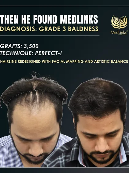 Here you can see the 'before' state and the initial markings for the new hairline design, planned with 3,500 grafts using our Perfect-i technique.