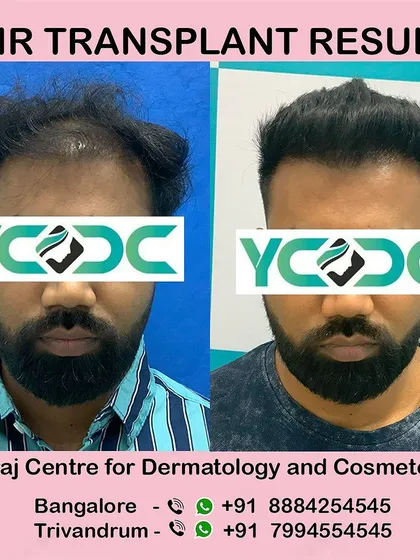 A frontal view of a successful FUE hair transplant. I meticulously design the hairline to frame the face naturally, avoiding any signs of artificiality. The result is a fuller head of hair that looks and feels like your own.