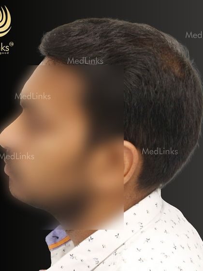 A different angle of the final result, demonstrating the quality of the transplant.