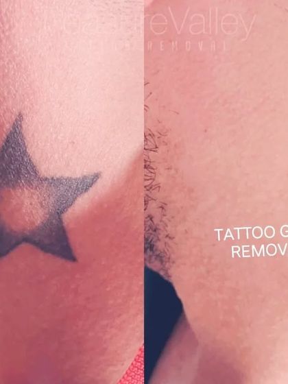 A solid black star tattoo removed from the neck. This is a sensitive area, but the process is quick and effective.