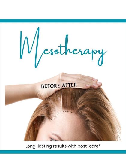 This graphic highlights the before-and-after results of Mesotherapy for hair, showing a fuller and healthier hairline.