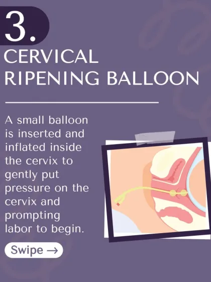 Method 3: A cervical ripening balloon. A small balloon is inflated inside the cervix to gently put pressure on it and prompt labor to begin.