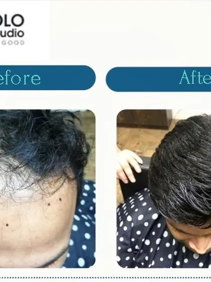 A top-down view of another successful hair patch application. We specialize in covering bald spots with custom solutions that are indistinguishable from real hair, transforming your look and confidence.