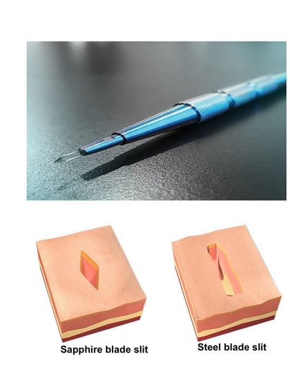 This diagram illustrates the advantage of using a Sapphire blade over a traditional steel blade for making incisions. The V-shaped slit created by the sapphire blade is smaller and allows for denser packing of grafts with less tissue trauma.