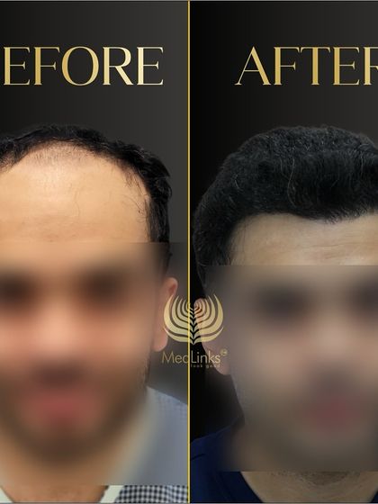 A before and after shot of a patient whose face is blurred for privacy, but the hair transformation is clear. The result is a full, natural-looking head of hair.