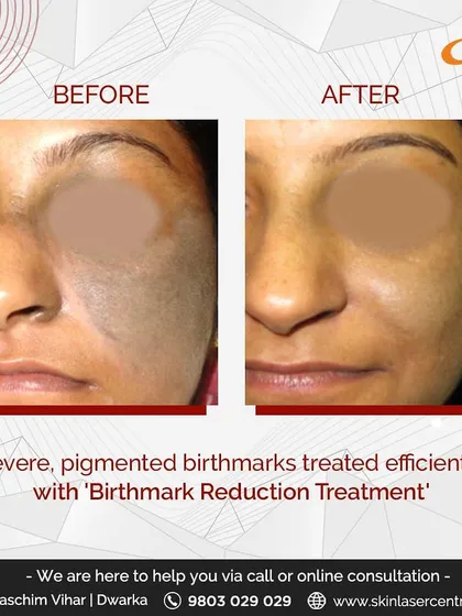 This patient was treated for a severe pigmented birthmark. Using a specialized birthmark reduction treatment, we were able to significantly lighten the area and even out the skin tone for a renewed appearance.