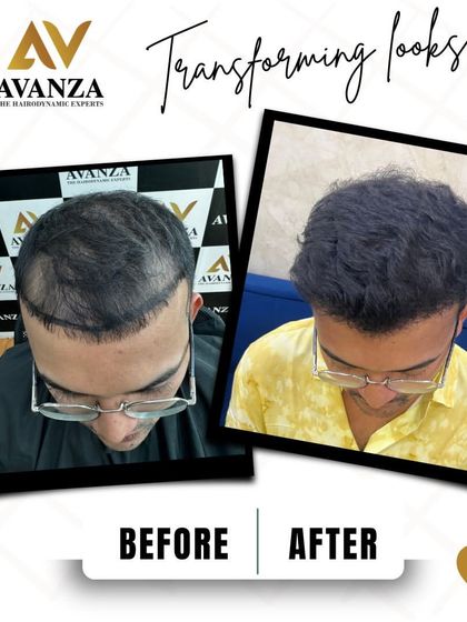 From "Oh no" to "Oh wow." This before and after shot shows the journey from a clearly defined balding pattern to a full, stylish head of hair.