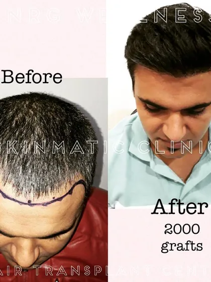 Patience leads to incredible results. This client's transformation, shown 10 months after receiving 2000 grafts via our BOOST FUE hair transplant, highlights the full, dense, and natural-looking outcome you can expect.