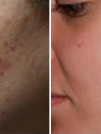 This patient's skin shows a visible reduction in both active acne lesions and the redness they cause. My treatment plans always prioritize calming the skin while targeting the root cause of acne.