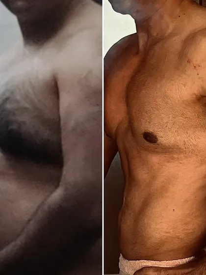 This client would ask me every week, "Isn't this too slow?" But he trusted the process and kept going. A year later, this is the result. Slow and steady progress leads to sustainable, life-changing results.