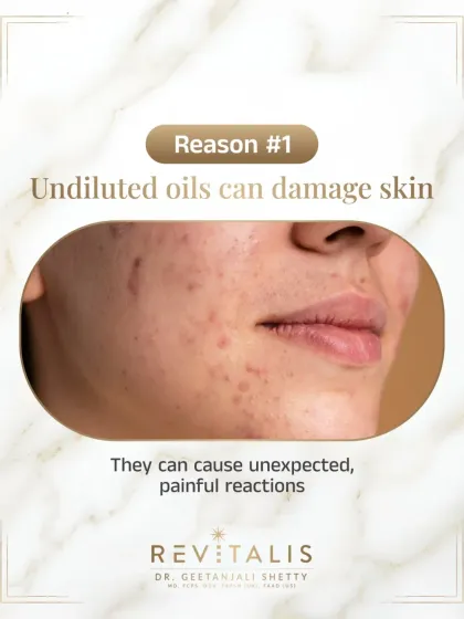 Reason 1: Undiluted Oils Can Damage Skin. A visual showing the potential for painful reactions and skin damage from applying potent, undiluted essential oils directly to the face.