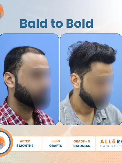 From Bald to Bold. This 8-month result for a Grade 5 case, using 3650 grafts, shows a complete transformation. The close-up of the hairline demonstrates the natural and dense packing of follicles.