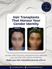 Gender-Affirming Hair Transplant
