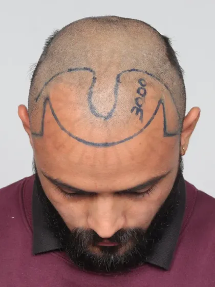 This shows the crucial first step: hairline design. We mark the area precisely to ensure the final result perfectly frames the face.