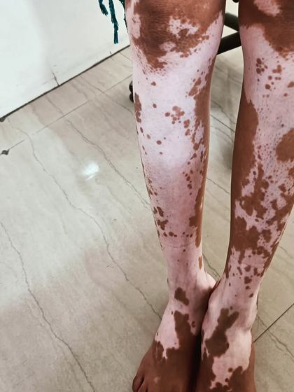 This is another example of Vitiligo vulgaris on the legs. My treatment is designed to be economical and successful, using advanced lasers and UVB therapy.