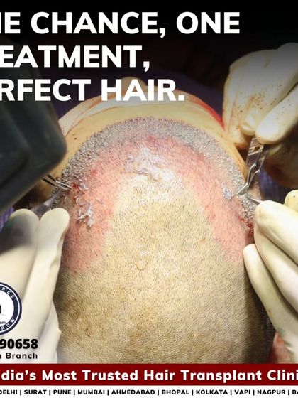 One chance, one treatment, perfect hair. This image captures the essence of a hair transplant surgery, where every single graft is placed with the goal of creating a perfect, lasting outcome.