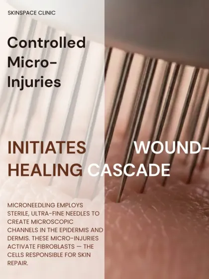 The microneedling process employs sterile, ultra-fine needles to create microscopic channels in the skin. These controlled micro-injuries initiate a wound-healing cascade, activating the fibroblast cells responsible for skin repair and collagen production.