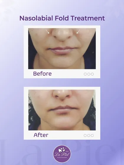 This image demonstrates the result of a Nasolabial Fold Treatment. By carefully restoring volume to the area around the nose and mouth, we can soften smile lines and create a smoother, more balanced facial appearance without looking "done."
