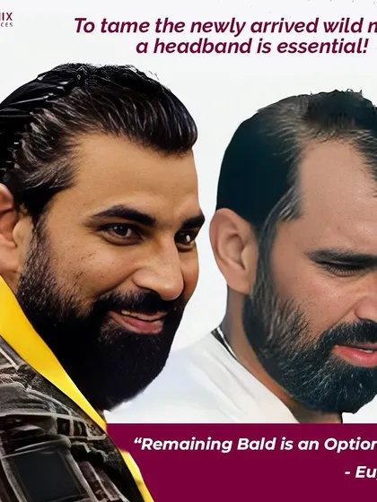 "Remaining bald is an option now." This powerful statement from a happy patient captures the essence of our work. We provide a choice and a path to regain the look you desire.