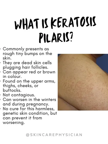 Keratosis Pilaris, or "chicken skin," can sometimes worsen during pregnancy. This harmless genetic condition is caused by dead skin cells plugging hair follicles, and while there's no cure, we can manage its appearance.