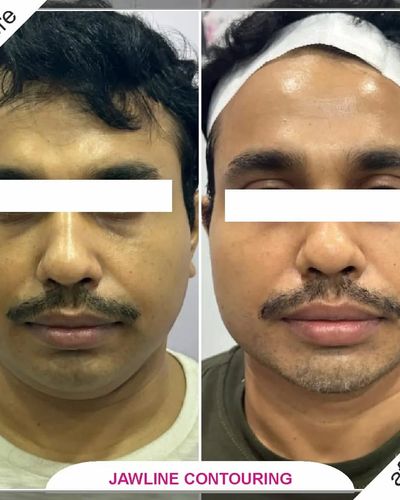 Anti-Aging & Face Contouring