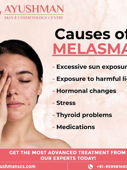 This graphic details the common causes of melasma, including sun exposure, hormonal changes, and stress. Understanding these triggers is key to effective management.