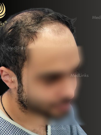 The patient's hair loss from the side before the procedure.