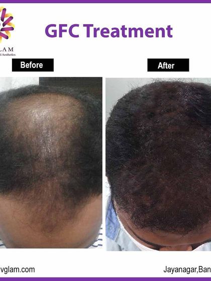 This client experienced significant hair regrowth and thickening after undergoing GFC treatment for male pattern baldness. The 'after' image shows a dramatic improvement in density across the scalp.