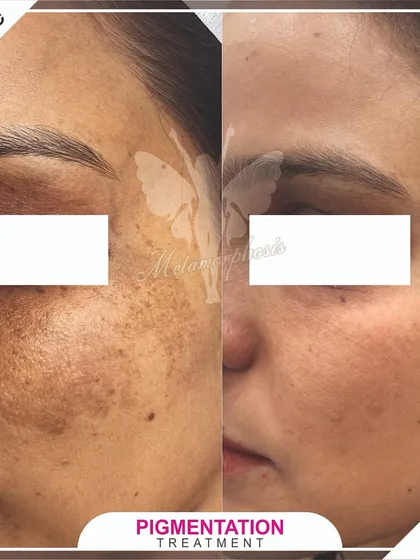 Stubborn pigmentation and sun damage don't stand a chance. Here you can see a significant clearing of hyperpigmentation, revealing a brighter and more even skin tone using a tailored plan of peels and laser sessions.