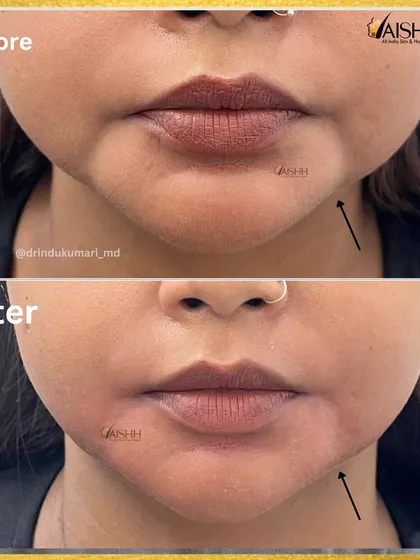 A frontal view showing the correction of a bulky jawline. This non-surgical approach provides a slimmer facial profile and enhances the chin and jaw definition.