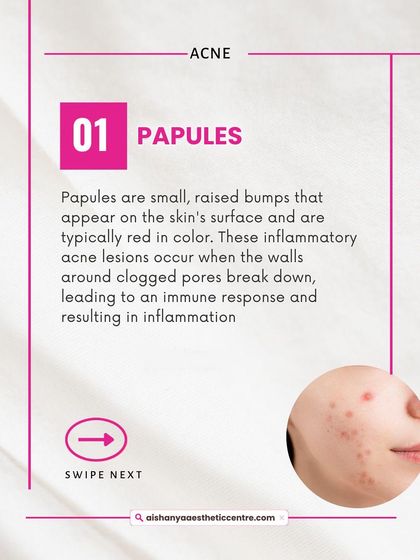 This graphic explains papules, which are the small, red, inflamed bumps common in acne. These occur when a clogged pore's walls break down, and they require specific treatments to reduce inflammation.
