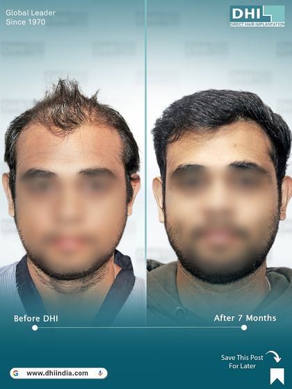 A frontal before and after of the same 27-year-old client. This image clearly shows the restored hairline and youthful appearance achieved just 7 months after his DHI hair transplant.