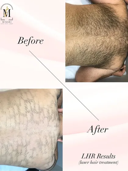 This treatment is highly effective for men too. This before and after shows the results of a laser hair treatment on a male client's back, demonstrating a dramatic reduction in hair density for a cleaner look.