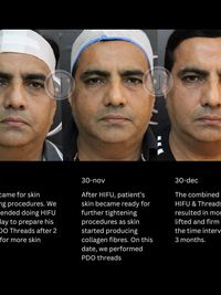 Anti-Aging & Skin Tightening