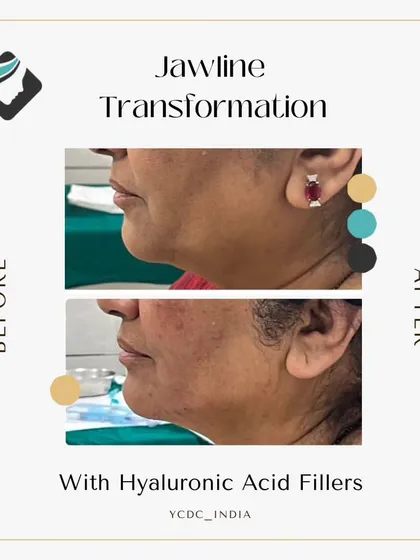 A defined jawline can significantly enhance your facial profile. Here, I used hyaluronic acid fillers to sculpt and contour the jaw, creating a sharper and more youthful look. This is a non-surgical procedure that provides immediate, transformative results for facial balancing.