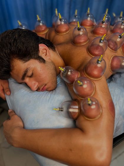 Another angle of a full-body dry cupping session, showing the extensive coverage on the back, shoulders, and arms to maximize the therapeutic benefits.