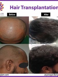 Hair Restoration