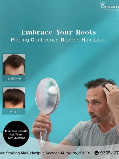This visual shows the kind of transformation that is possible with consistent hair restoration treatments. By addressing hair loss at the root, my goal is to help you see visible improvement in hair density and coverage over time.