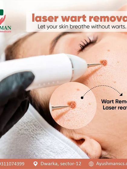 Let your skin breathe without warts. This image shows the precision of my laser wart removal treatment, which effectively targets and removes warts for clear, smooth skin.