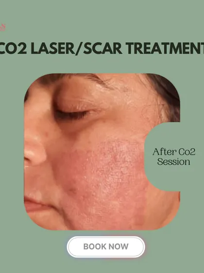 Immediately after a CO2 laser session, the skin shows redness, which is a normal part of the healing process. This indicates that the treatment is stimulating collagen production and beginning the skin renewal cycle.
