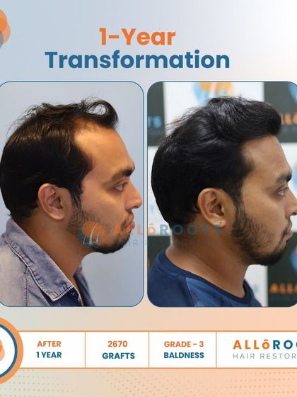 After one year, this patient's Grade 3 baldness was fully addressed with 2670 grafts. The transformation is evident in his smile and the natural, dense hairline that frames his face.