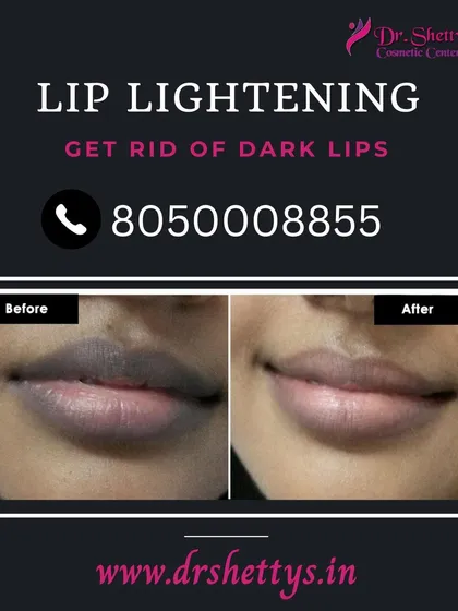 This before and after image shows the significant results of our laser lip lightening treatment. We can effectively reduce dark pigmentation, giving you lighter, more evenly toned lips with a safe and permanent procedure.