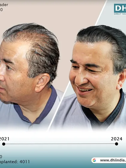 A side-profile view of the same client's 3-year transformation. The hair looks healthy, dense, and completely natural, demonstrating the permanence and quality of the DHI technique.