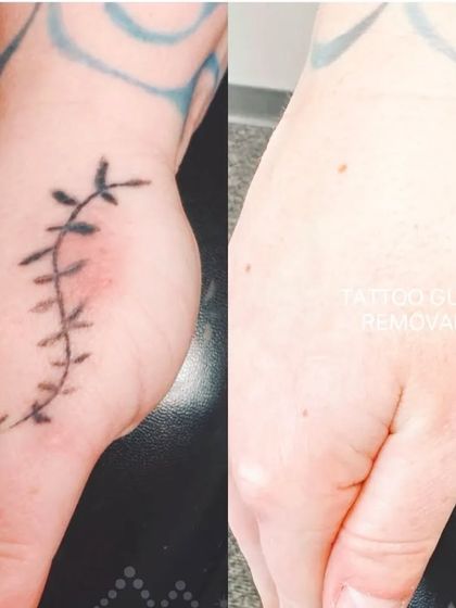 A plant-like design removed from the side of the hand. The after photo shows the skin has healed well with the tattoo completely gone.