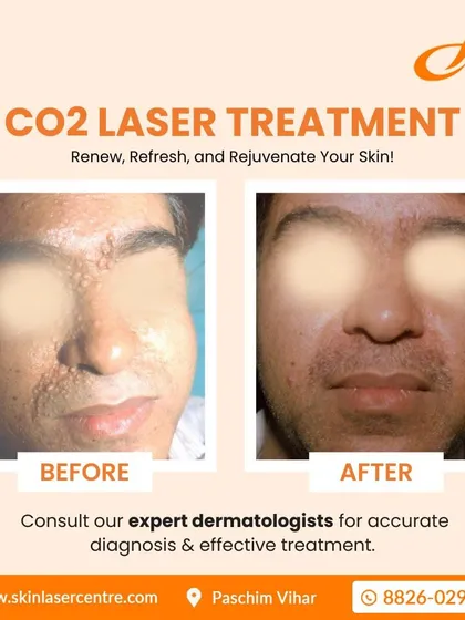 This before and after image shows the significant improvement possible with CO2 laser treatment. I used this precise laser to safely remove multiple growths from the patient's face, resulting in much smoother and clearer skin. This is a powerful tool for skin resurfacing.