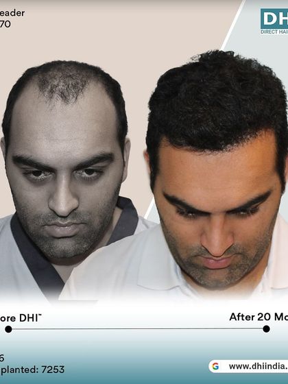 Another side-profile view of the 20-month result. The client's full head of hair and confident appearance speak volumes about the success and satisfaction delivered by his DHI procedure.
