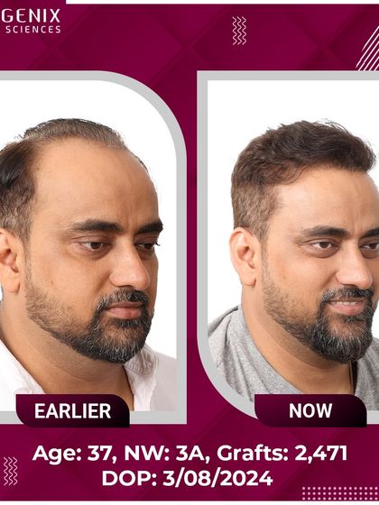 The confident smile of this 37-year-old after his 2471-graft procedure says it all.