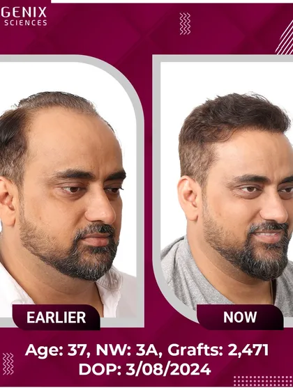The confident smile of this 37-year-old after his 2471-graft procedure says it all.